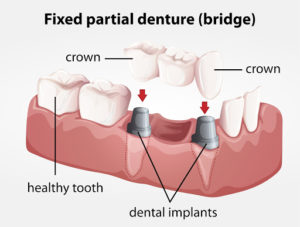 Illustration of a Fixed partial denture bridge