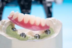 implant retained dentures