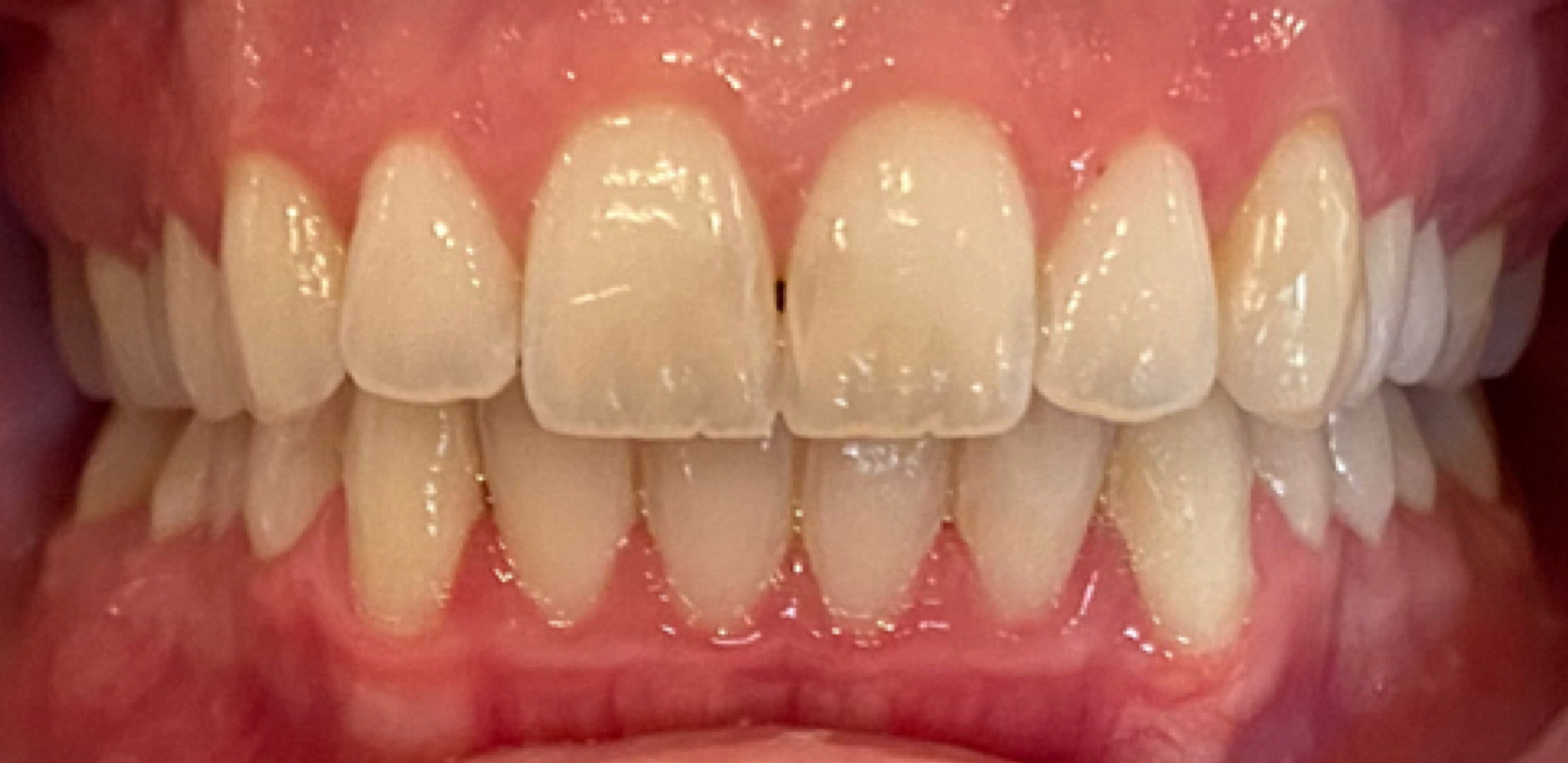 Veneers vs. Braces: Your Questions Answered - Northside Dental Co.