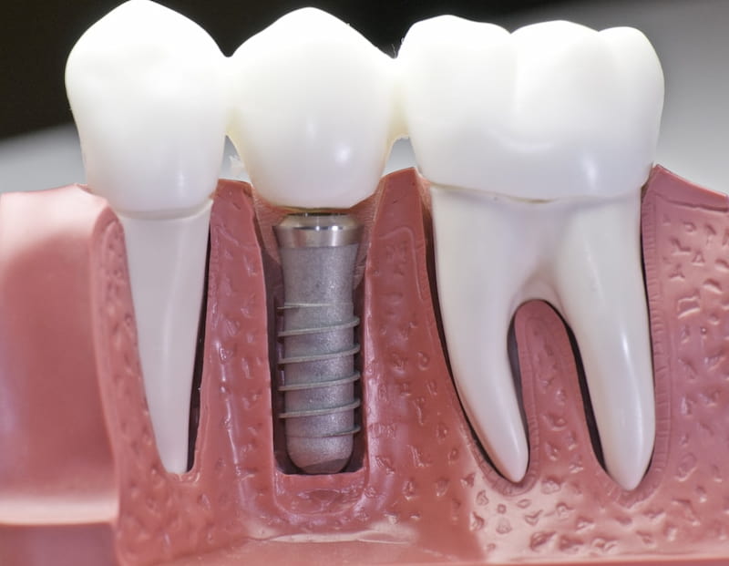 Are Dental Implants a Good Idea?