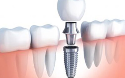 How To Find the Best Dental Implant Specialist Near Me