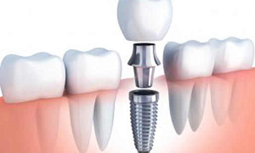 How To Find the Best Dental Implant Specialist Near Me