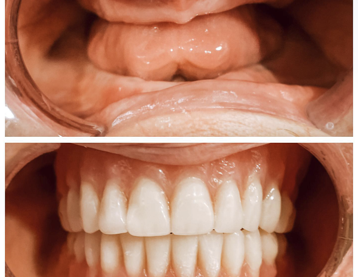 Where Can I Get Dentures That Look Real? Northside Dental Co.