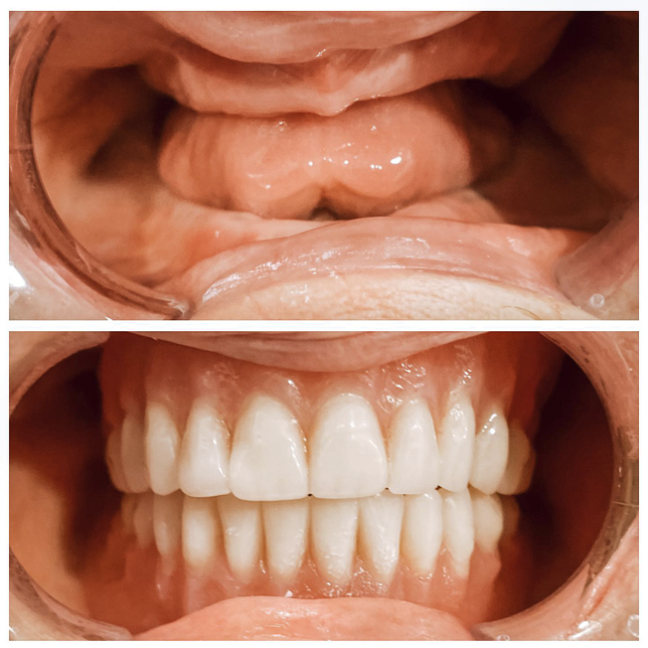 Where Can I Get Dentures That Look Real? - Northside Dental Co.