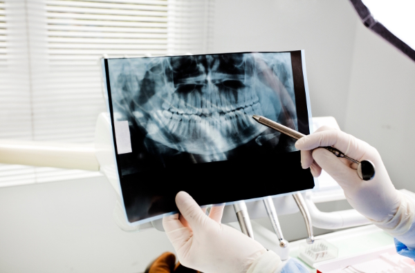 Digital X-rays dental x ray